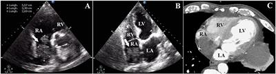 Massive Right Atrial Thrombosis: Are You Brave Enough to Start Anticoagulation? A Case Report